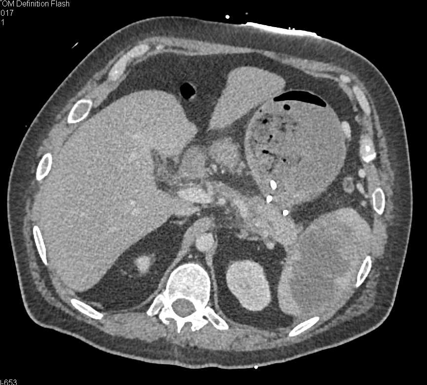 Splenic Infarcts - CTisus CT Scan