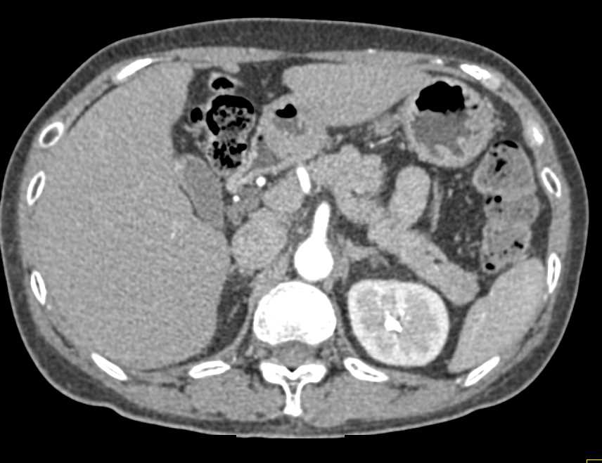 Splenule Tail of the Pancreas - CTisus CT Scan