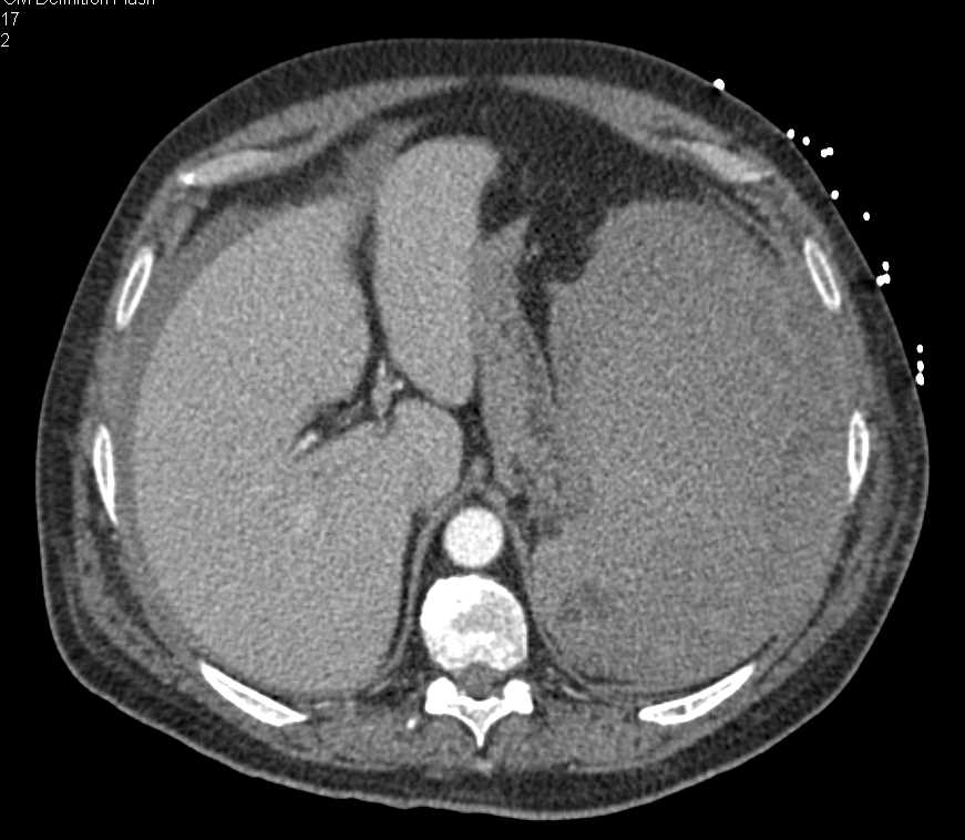 Chronic Lymphocytic Leukemia (CLL) with Active Bleed in the Spleen - CTisus CT Scan