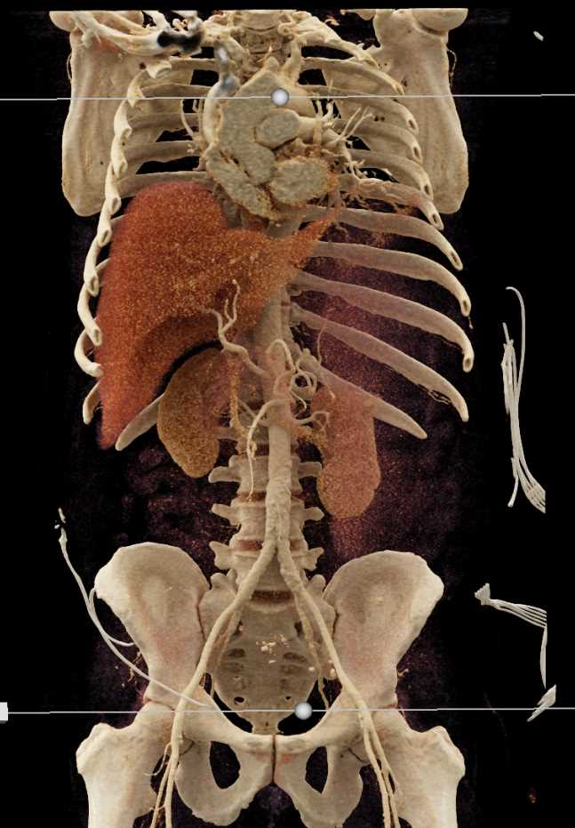 Chronic Lymphocytic Leukemia (CLL) with Active Bleed in the Spleen - CTisus CT Scan