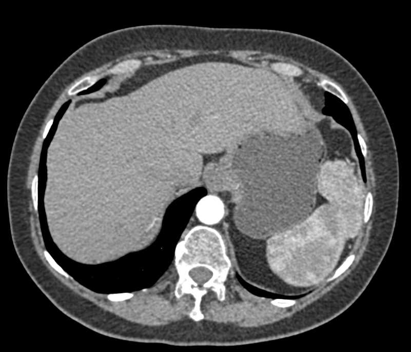 Unusual Accessory Spleen - CTisus CT Scan