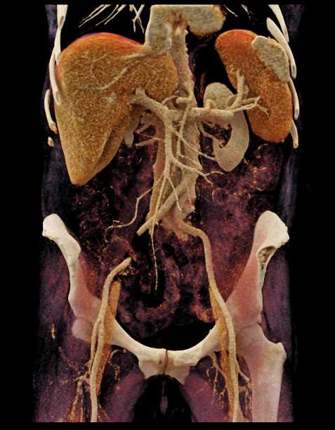 Unusual Accessory Spleen with CR - CTisus CT Scan