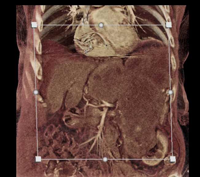 Lymphoma - CTisus CT Scan