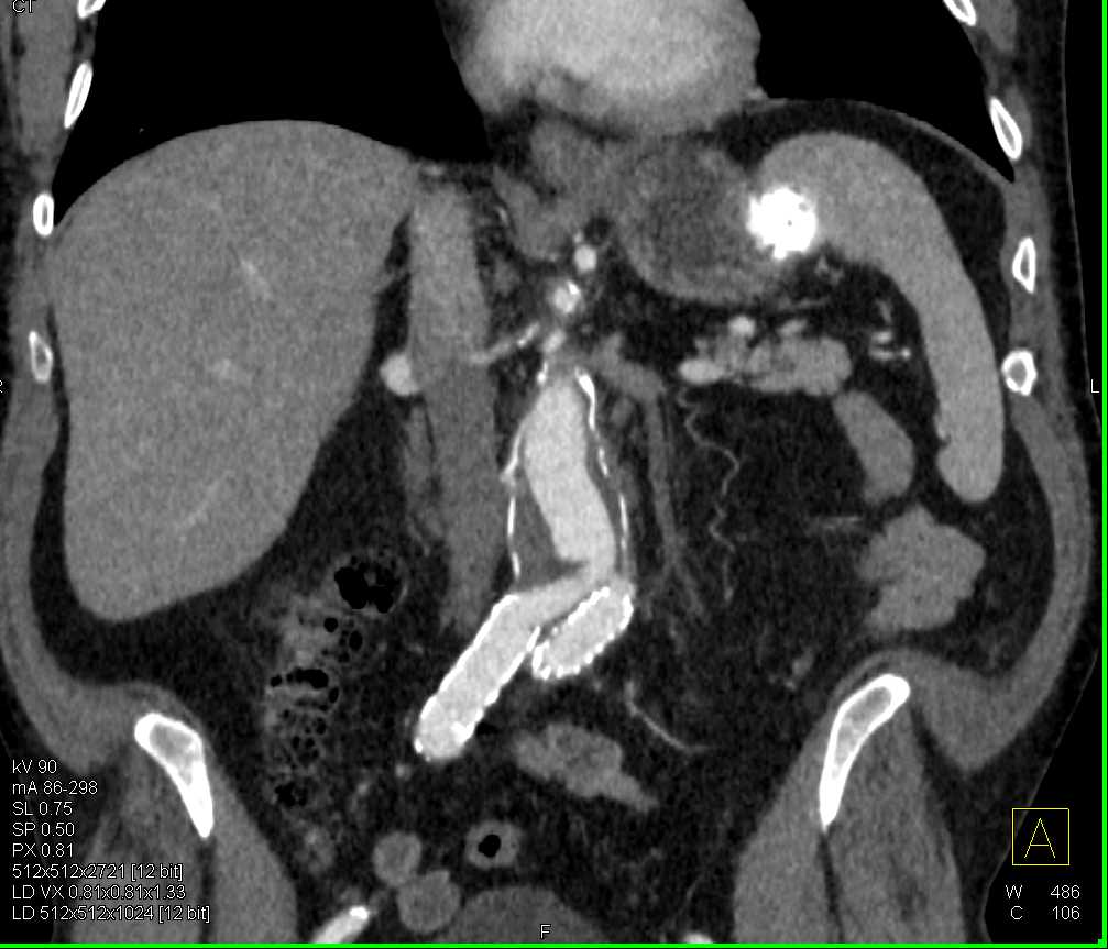 Splenic Cyst from Old Trauma - CTisus CT Scan