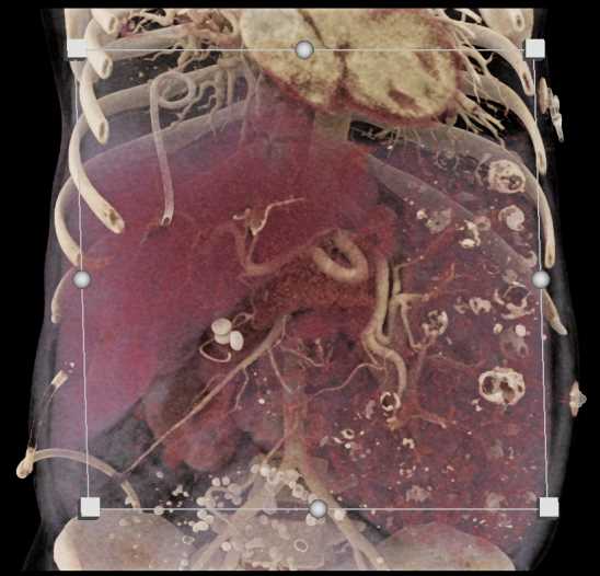 Splenic Hemangioma and KTW SYndrome - CTisus CT Scan