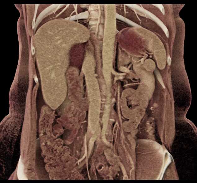 Splenule Tail of Pancreas Simulates a PNET - CTisus CT Scan