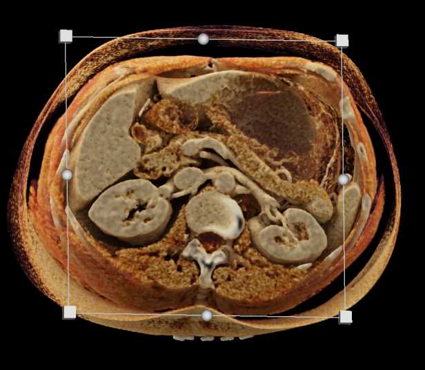 Splenule Tail of Pancreas Simulates a PNET - CTisus CT Scan