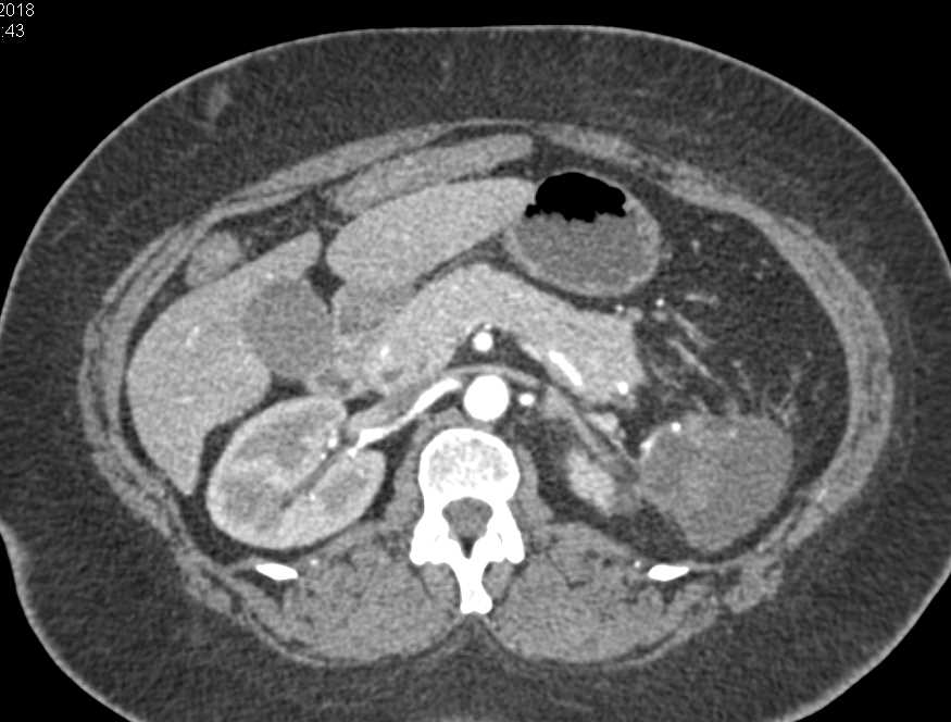 Splenic Laceration and Bleed - CTisus CT Scan