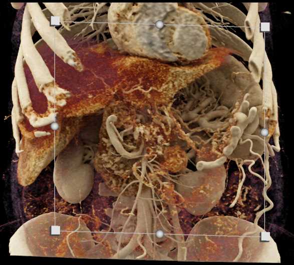 CR Mapping of Splenic Vascular Anatomy - CTisus CT Scan