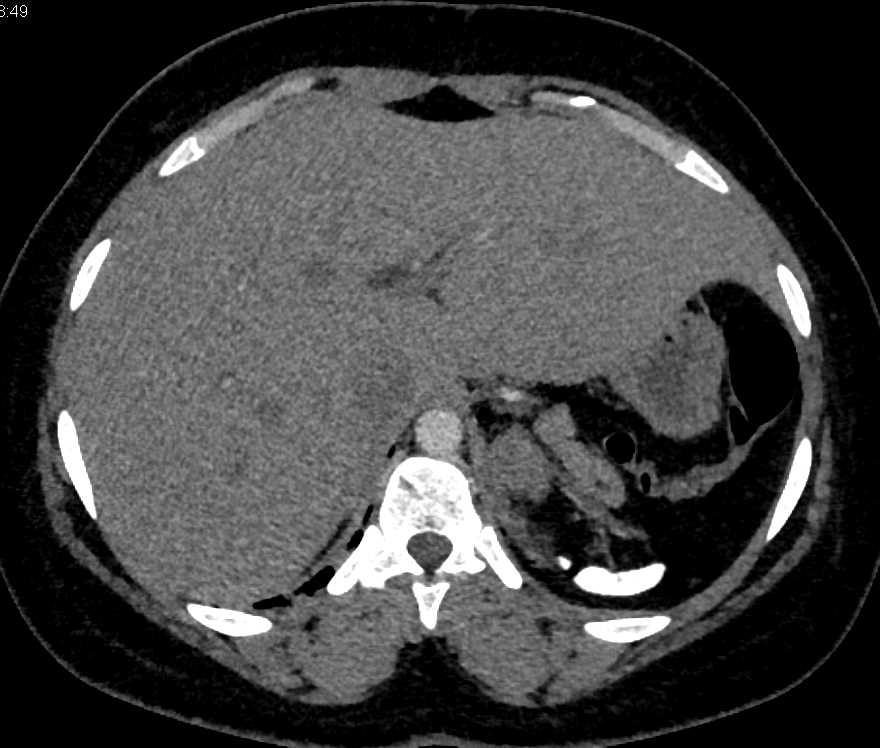 Sickle Cell Disease with Auto-Splenectomy - CTisus CT Scan