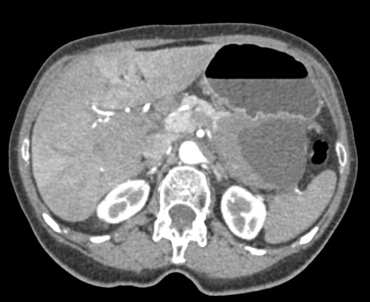 Pseudocyst Tail of Pancreas - CTisus CT Scan