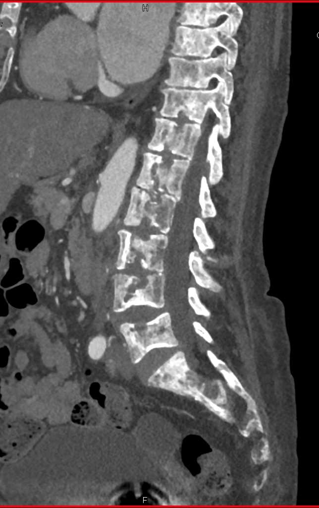 Sickle Cell Disease with Autoinfarcted Spleen - CTisus CT Scan