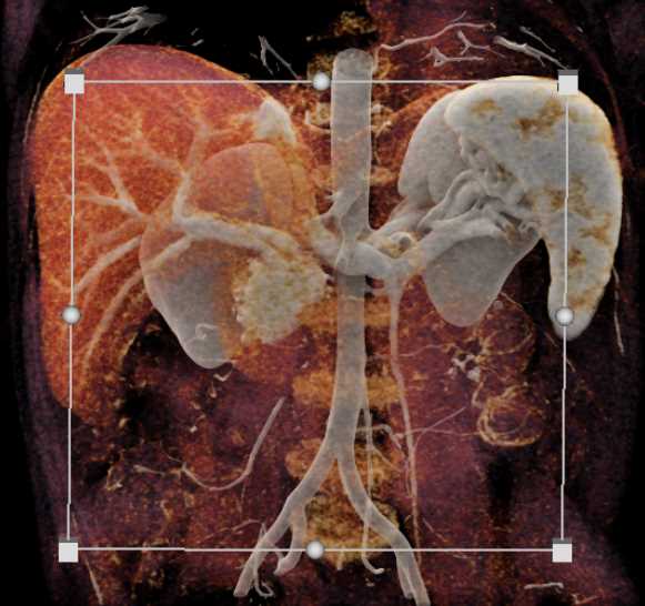 Cinematic Rendering of the Spleen - CTisus CT Scan