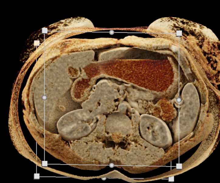 Cinematic Rendering of the Spleen - CTisus CT Scan