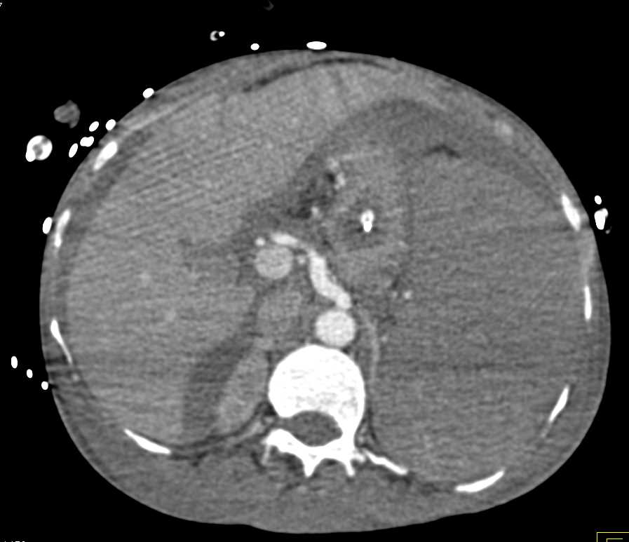 Splenic Infarcts - CTisus CT Scan