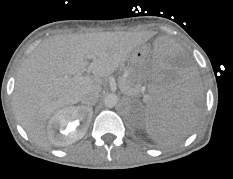 Splenomegaly with Multiple Splenic Infarcts - CTisus CT Scan