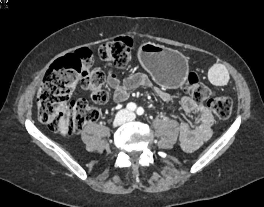 Accessory Spleen in the Left Lower Quadrant (LLQ) - CTisus CT Scan