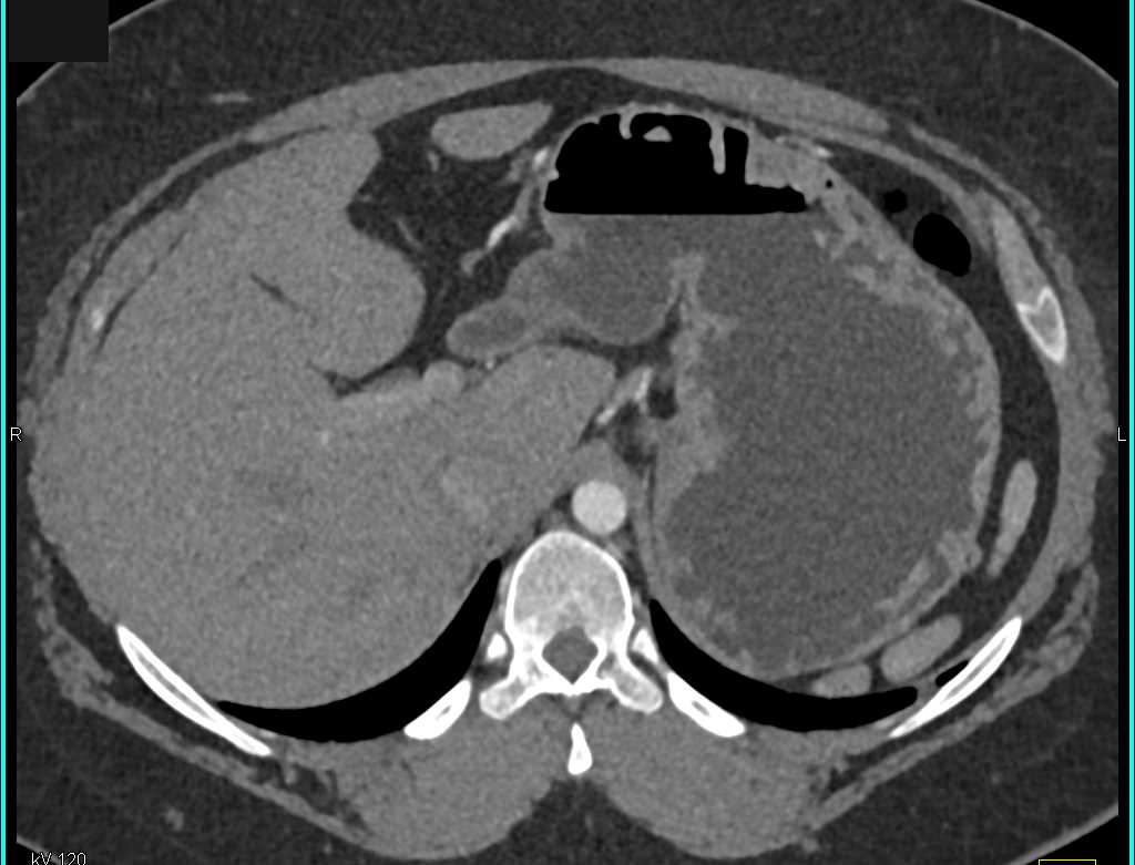 Multiple Splenules - CTisus CT Scan