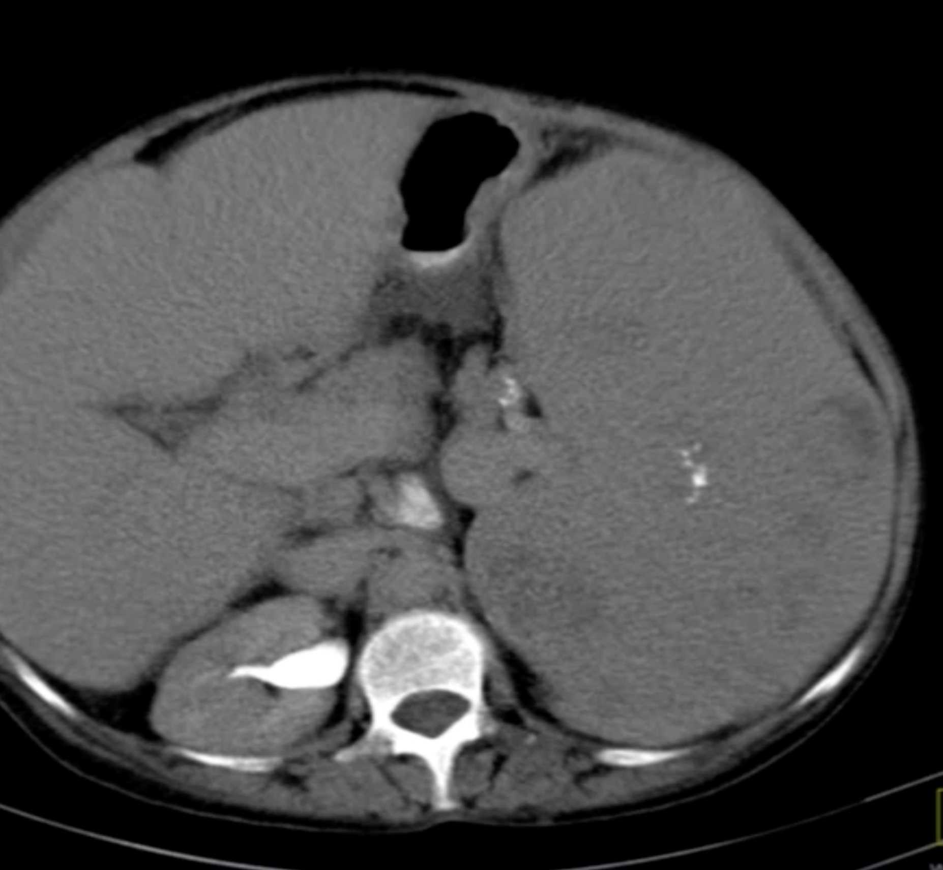 Gaucher's Spleen - CTisus CT Scan