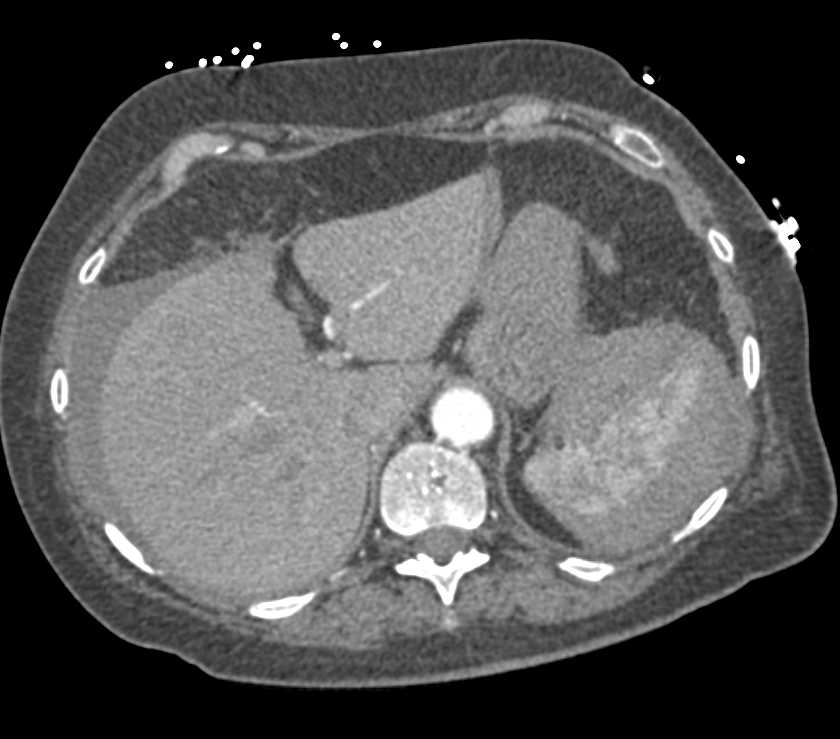 Splenic Laceration and Bleed - CTisus CT Scan