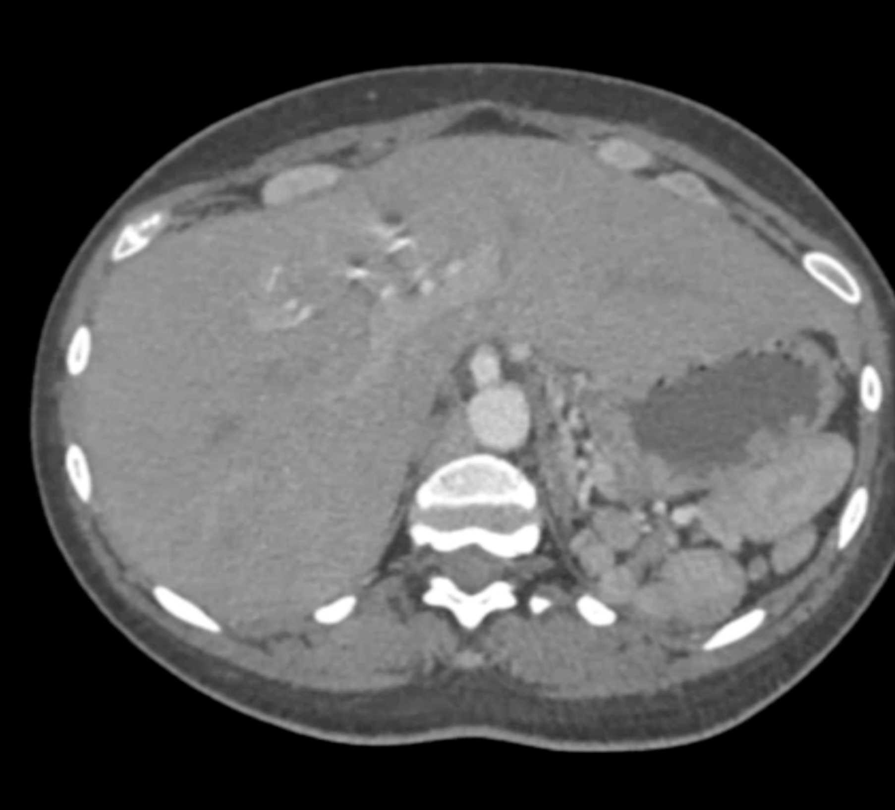 Interrupted Inferior Vena Cava (IVC) with Polysplenia - CTisus CT Scan