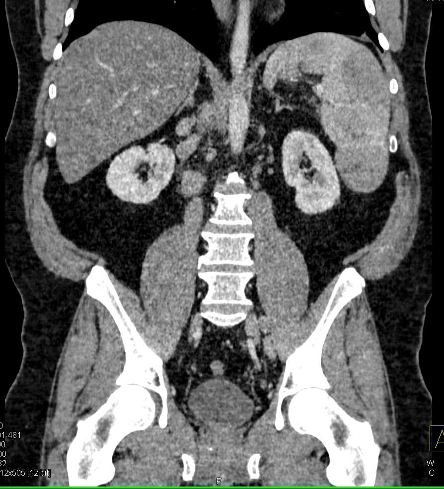 B-Cell Lymphoma Spleen - CTisus CT Scan