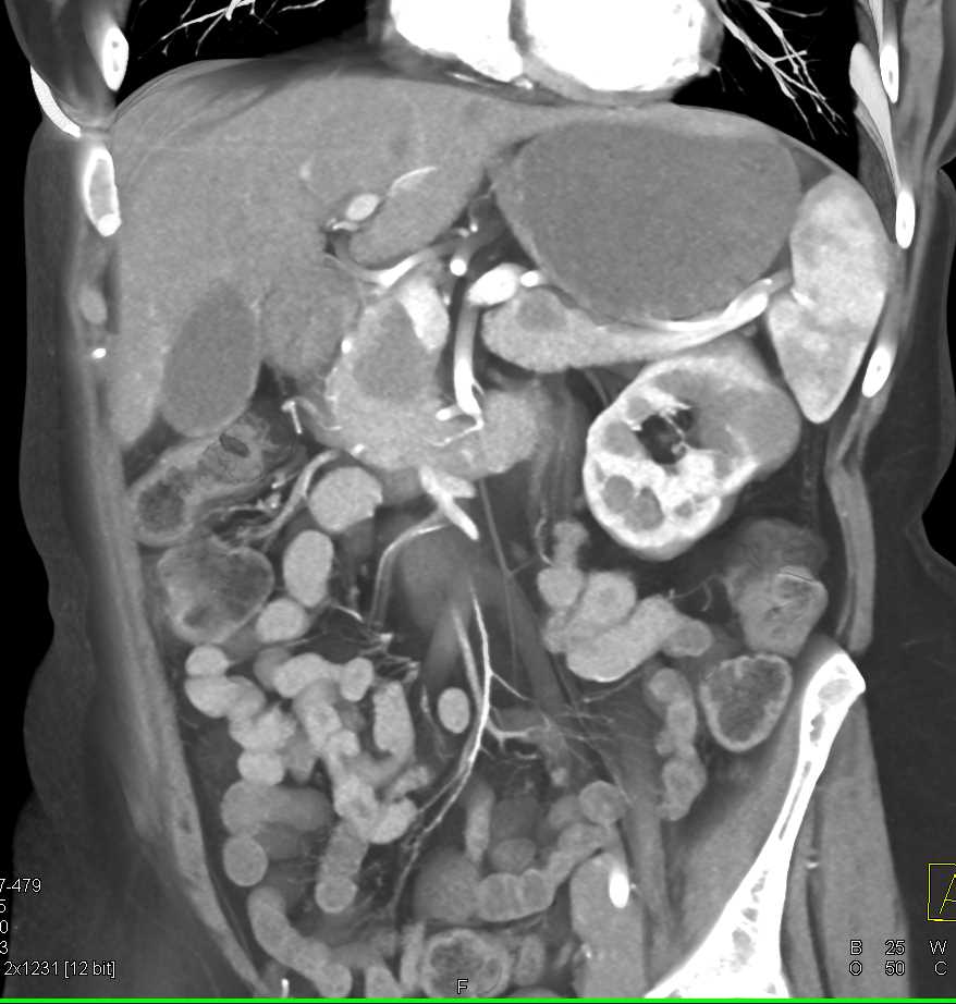 B-Cell Lymphoma - CTisus CT Scan