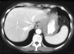 Gastric Adenocarcinoma With Celiac Nodes - CTisus CT Scan