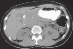 Gastric Adenocarcinoma Invades Gastrocolic Ligament and Infiltrates the Transverse Colon - CTisus CT Scan