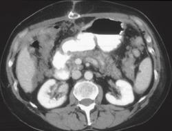 Metastasis to the Gastric Antrum From Breast Cancer - CTisus CT Scan