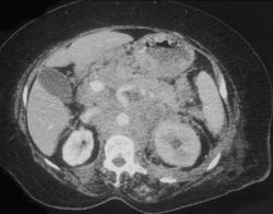 Gastric Cancer With Extensive Adenopathy - CTisus CT Scan