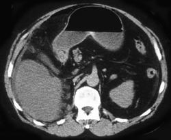 Subtle Antral Tumor Causing Gastric Outlet Obstruction - CTisus CT Scan