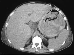 Hemorrhagic Gastritis in A Bone Marrow Transplant Patient. the Patient Eventually Died. - CTisus CT Scan