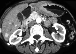 Antral Carcinoma - CTisus CT Scan