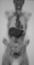 Antral Cancer With PET/CT Correlation - CTisus CT Scan