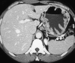 Gastritis - CTisus CT Scan