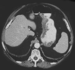 Bezoar Simulates A Tumor - CTisus CT Scan