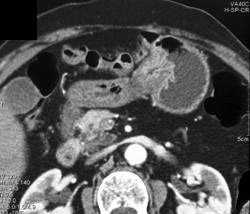 Antral Gastritis Simulates Carcinoma - CTisus CT Scan