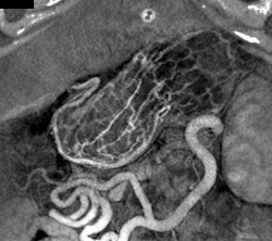 Normal Gastric Folds - CTisus CT Scan