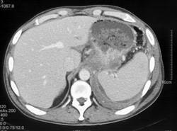 Diffuse Infiltration of the Gastric Fundus - CTisus CT Scan