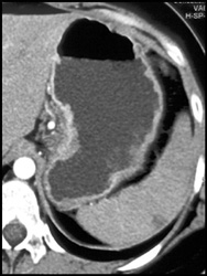 Celiac Nodes in Gastric Cancer - CTisus CT Scan