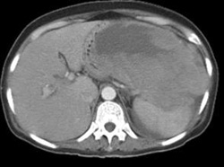 GIST Tumor - CTisus CT Scan