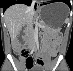Gastric Polyps and Duodenal Cancer - CTisus CT Scan