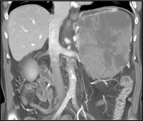 GIST Tumor - CTisus CT Scan