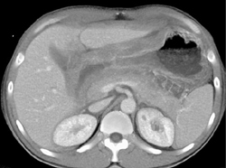 Gastric Lymphoma - CTisus CT Scan
