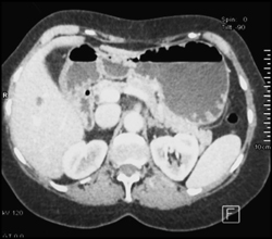 Gastric Hyperplastic Polyps - CTisus CT Scan