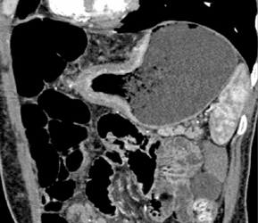 Gastric Adenocarcinoma - CTisus CT Scan