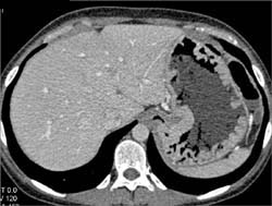 Gastric Adenocarcinoma - CTisus CT Scan