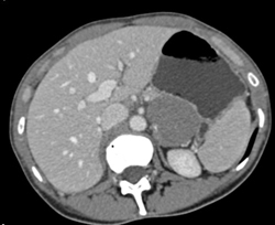 GIST Tumor - CTisus CT Scan