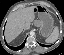 Splenic Artery Aneurysm Simulates A GIST Tumor - CTisus CT Scan